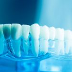 Know More about teeth implants